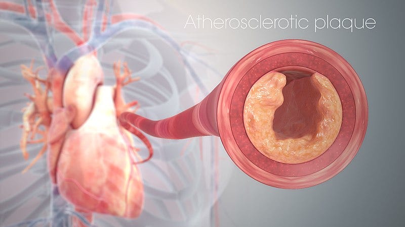 Atherosclerotic plaque related to cholesterol levels